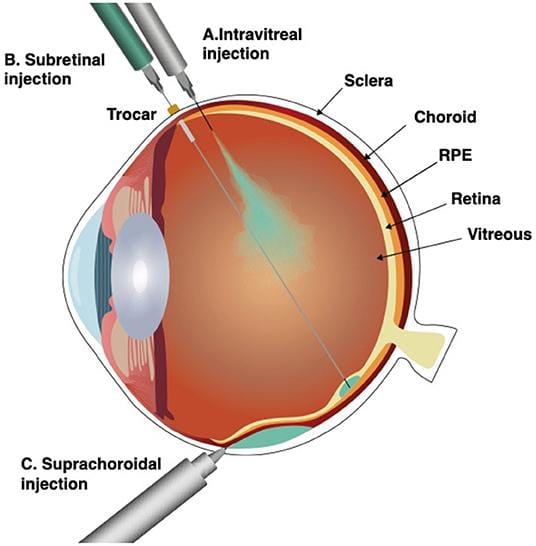 Subretinal Pocket Creation Improves Cell Graft Survival in Dry AMD Model